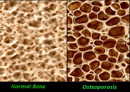A holistic, natural healthcare perspective on osteoporosis